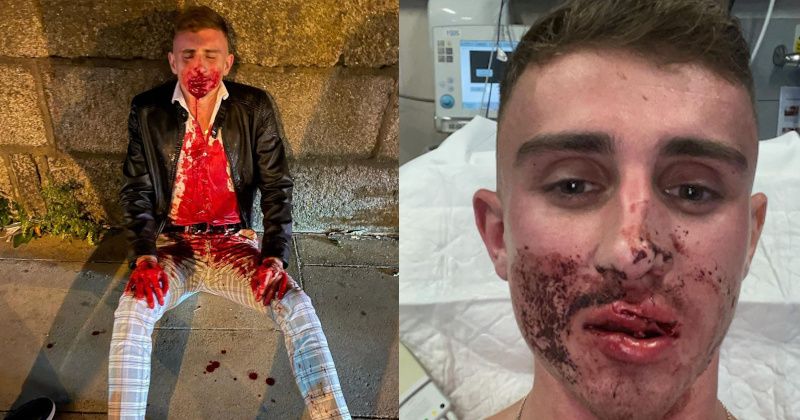 Olympic Fighter Brutally Injured in Random Mob Attack in Dublin