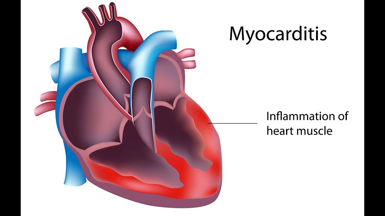 New study finds the Covid-19 vaccine is to blame for 98% of cases of myocarditis among children