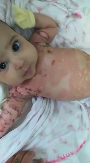 Brazil Baby Develops Auto Immune Disease After Being Breastfed By Pfizer Vaccinated Mother