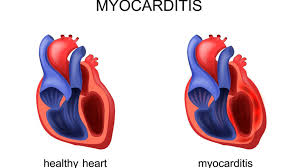 New study: 133x risk of myocarditis after vaccination – World-Signals News