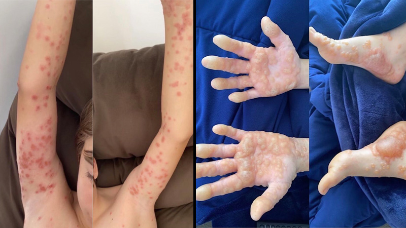 12-Year-Old Suffers Painful Blisters All Over Body Following 1st Moderna Dose – Doctors Still Urge 2nd Dose