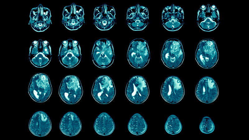 Over 100 Ex-Students At One High School Diagnosed With Rare Deadly Brain Cancer – Nearby Uranium Plant To Blame?