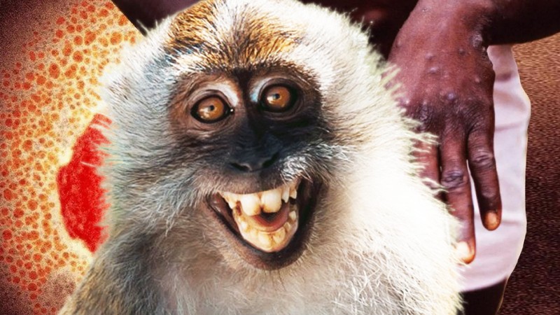 Monkeypox – How Bad Is It?