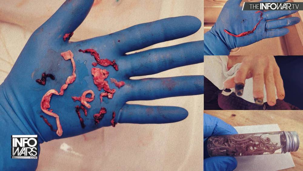 WATCH: Doctor Shocked By Epidemic Of Mysterious Clots Found In Suddenly Deceased Vaccinated Adults