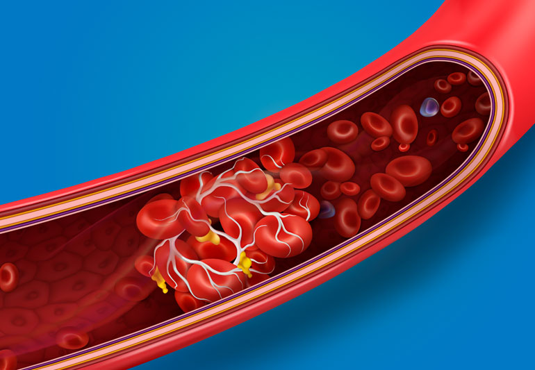 Modern experts: Blood clots arise from dehydration – World-Signals News
