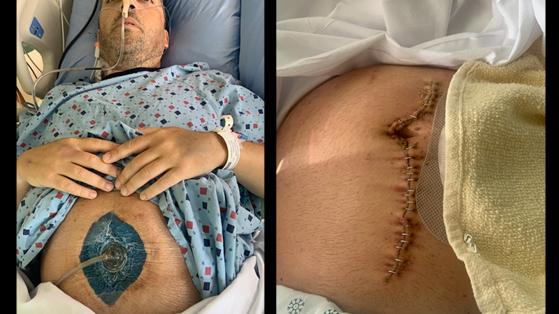 Photos Show Horrific Covid Vaccine Injury: Man Loses 6 Feet of Small Intestine Due to Blood Clot