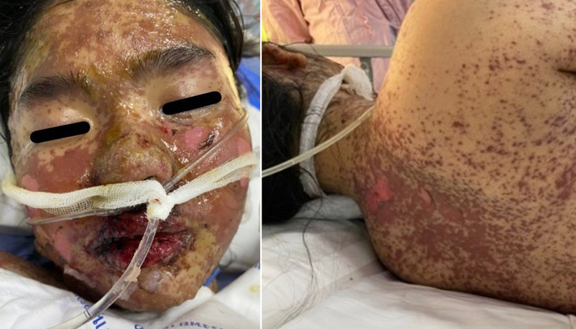 12-åring fick Pfizers coronavaccin – en vecka senare såg hon ut så här | Fria Tider