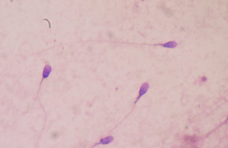 Path to extinction? Sperm count accelerates its decline - Resilience