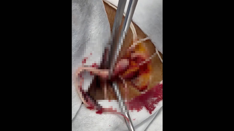 Graphic Video: Embalmer Removes White Fibrous Clots From Jugular Vein, Suggests COVID Vaccine Responsible