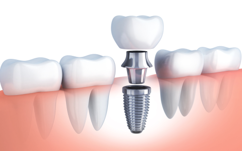 What is a bone graft for teeth? Learn the process, costs, and recovery tips fast.